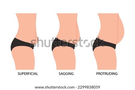 Oerweight. Sagging, protruding and superficial tummy. Types bellies of human body Royalty-Free Stock Photo #2299838059