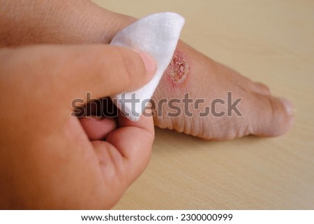 closeup of weeping wound, trophic ulcer on female leg, wound exudate prevents healing ulcers by destroying growth factors, concept of self-treatment at home, sanitation pathogenic microflora Royalty-Free Stock Photo #2300000999