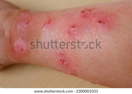 closeup weeping wounds, venous ulcers on female leg, diabetes mellitus, varicose veins, healing ulcers by destroying growth factors, eliminating inflammatory process, sanitation pathogenic microflora Royalty-Free Stock Photo #2300001033