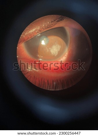 Corneal ulcer by Herpes simplex Royalty-Free Stock Photo #2300256447