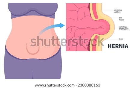 volvulus constipation intestine abdominal pain belly button of inguinal incisional Femoral stomach diastasis recti small large ileus lump navel wall cavity baby infant birth umbilical hernia Hiatus Royalty-Free Stock Photo #2300388163