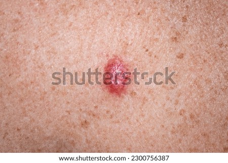 Young female 30s close up of chest prior to applying imiquimod cream medication to basal cell carcinoma. Royalty-Free Stock Photo #2300756387