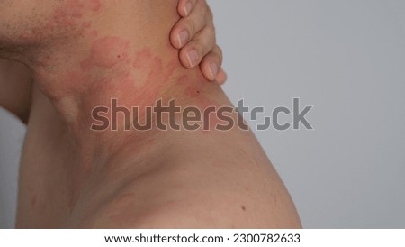 Close up image of skin texture suffering severe urticaria or hives or kaligata on neck. Allergy symptoms. Royalty-Free Stock Photo #2300782633