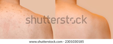 Closeup back red rash skin with acne scar on young woman back and shoulder. Image compare before treatment on dark spot acne pimples scar to clear skin after treatment. Royalty-Free Stock Photo #2301030185
