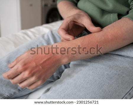 Man scratches hand, red damaged skin. Excoriation neurotic disorder, skin scratching, emotional stress or allergies Royalty-Free Stock Photo #2301256721