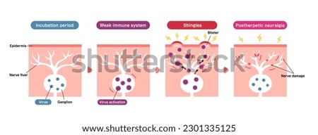 Mechanism of shingles ( herpes zoster ) vector illustration (including postherpetic neuralgia) Royalty-Free Stock Photo #2301335125