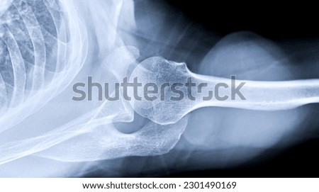 X-ray Shoulder joint shoulder transaxillary view for diagnosis fracture of shoulder joint. Royalty-Free Stock Photo #2301490169