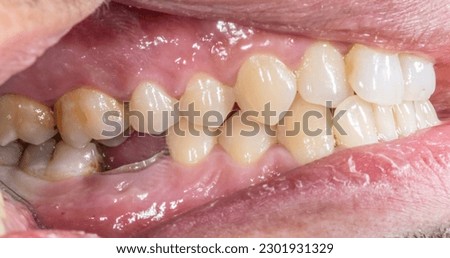 Lateral view of dental arches in occlusion with a lower molar decayed and destroyed crown. Macrophotography lateral mirror indirect view with cheek retractors, lips and gingival gum visible.  Royalty-Free Stock Photo #2301931329