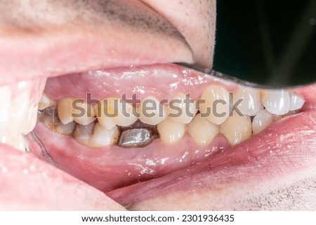 Lateral view of dental arches in occlusion with a lower molar decayed and destroyed crown, restored with a prosthodontic metallic post and core build-up. Lateral mirror indirect view  Royalty-Free Stock Photo #2301936435