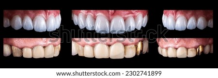 creating new smile with emax crowns and veneers bl2 color Royalty-Free Stock Photo #2302741899