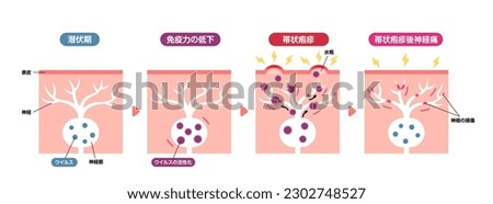 Mechanism of shingles ( herpes zoster ) vector illustration (including postherpetic neuralgia). 
Translation: Incubation period, Weak immune system, Shingles, Blister, Epidermis, Nerve fiber, Virus