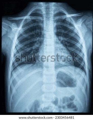 X ray photo image of chest area of young kid. X-ray lungs radiography  Royalty-Free Stock Photo #2303456481