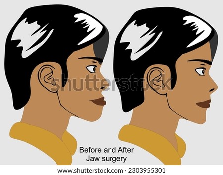 Jaw surgery orthognathic surgery vector illustration
