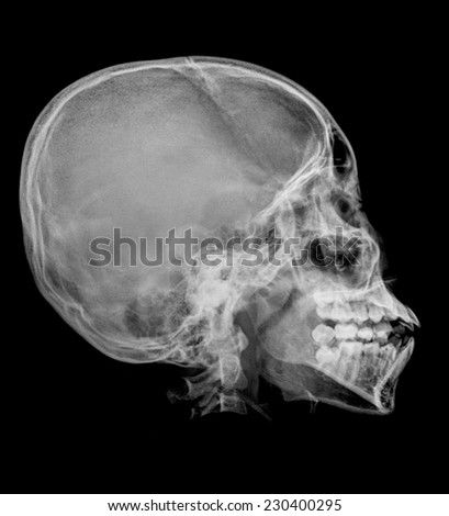 photo of side x-ray picture of human skull