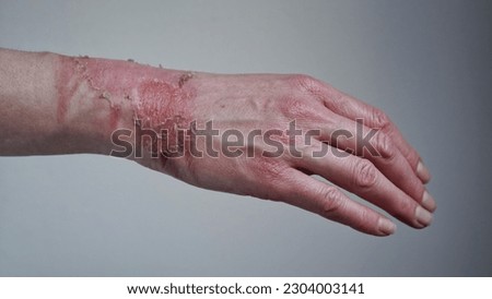 Close-up of a woman's hand with a burst blister from a boiled water burn, broken skin, 1st or 2nd degree burn. Painful wound. Thermal burn. Skin peels off after a burn, wound treatment. macro photo. Royalty-Free Stock Photo #2304003141