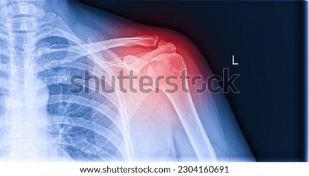 X-ray image of shoulder pain, shoulder ligament tendinitis, shoulder muscle strain Royalty-Free Stock Photo #2304160691