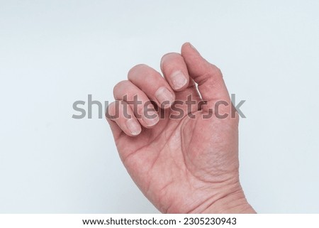 Bitten and broken nails without manicure with an overgrown cuticle of the nail and a damaged nail plate after applying gel polish. A woman's palm. Cosmetic procedures. Nail and hand care. Royalty-Free Stock Photo #2305230943