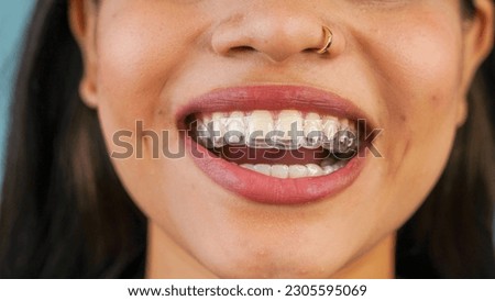 Young Asian Indian woman holding removable invisible aligner, also known as invisalign or  clear aligner Royalty-Free Stock Photo #2305595069