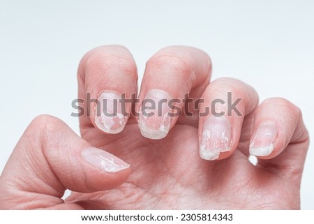 Flaky bitten and brittle nails without a manicure. Regrown nail cuticle and damaged nail plate after gel polish. Royalty-Free Stock Photo #2305814343