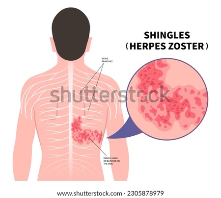 Shingles Herpes Zoster virus on body and skin itching rash blister sores of varicella chickenpox pain torso Vaccine Royalty-Free Stock Photo #2305878979