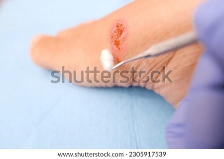 doctor treats weeping wound, trophic ulcer on female leg, wound exudate prevents healing ulcers by destroying growth factors, concept eliminating inflammatory process, sanitation pathogenic microflora Royalty-Free Stock Photo #2305917539