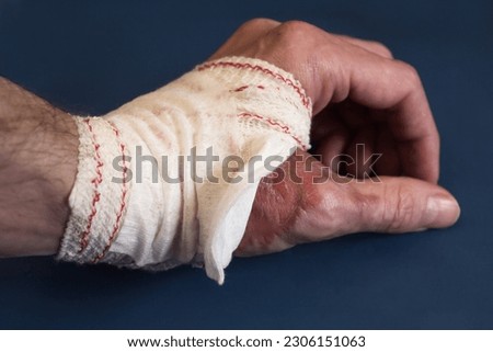 A close-up of a partially spiral bandaged hand resting on a blue table exposing remnants of a second-degree burn in the thumb area. First aid and wound healing. Royalty-Free Stock Photo #2306151063