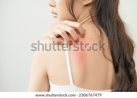 Dermatology, asian young woman, girl allergy, allergic reaction from atopic, insect bites on her back, hand in scratching itchy, itch red spot or rash of skin. Healthcare, treatment of beauty. Royalty-Free Stock Photo #2306767479