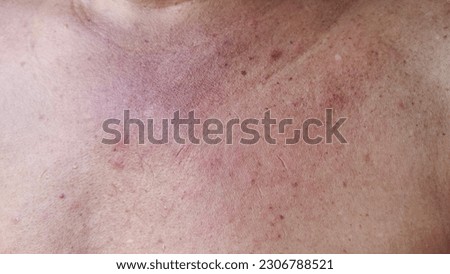 portrait the allergic and rash hives itchy skin,dermatitis inflammation skin, dark spots and acne, freckles and blemish, blackhead and pimple on the body of the male patient, health care concept.