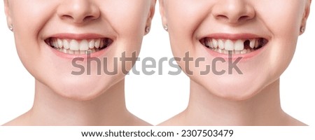 Young woman smiling before and after dental implant. Royalty-Free Stock Photo #2307503479