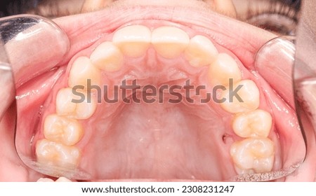 Upper maxillary arch, indirect occlusal view with buccal photography mirror. A hole in the palate, healthy gingival gum, teeth aligned and no decay. Cheeks and lips retracted with cheek retractor. Royalty-Free Stock Photo #2308231247
