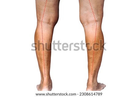Knee arthritis on the medial inner side in Elderly man Varus knee deformity type c or bow legs.elderly health concept. Royalty-Free Stock Photo #2308614789