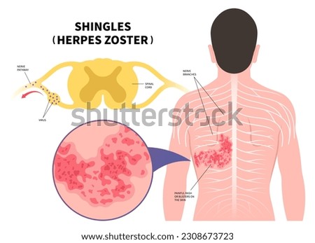 Nerve medical anatomy with Shingles Herpes Zoster virus on body and skin itching rash blister sores of varicella chickenpox pain torso Vaccine Royalty-Free Stock Photo #2308673723