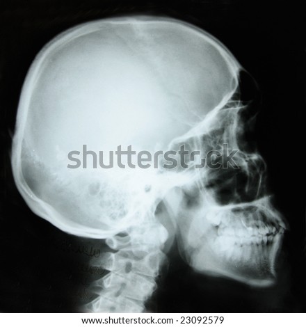 photo of side x-ray picture of human skull in natural colors