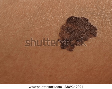 melanoma - a malignant tumor of the skin Royalty-Free Stock Photo #2309347091