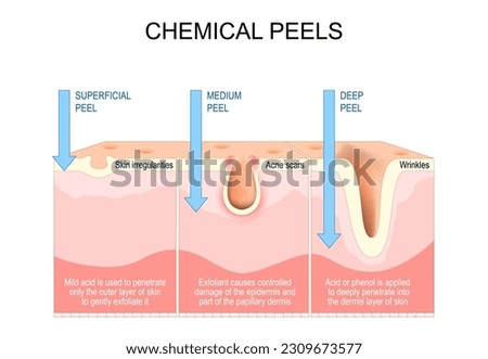 Chemical peels. Exfoliation. rejuvenation of face for Wrinkles, and Acne scars. Treatment of skin irregularities, hyperpigmentation. Cross section of a human skin. Vector illustration Royalty-Free Stock Photo #2309673577