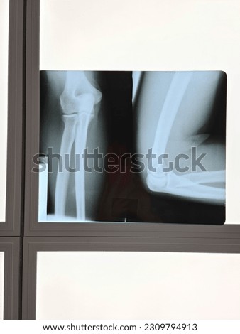 Film x-ray elbow and show the elbow of a normal person