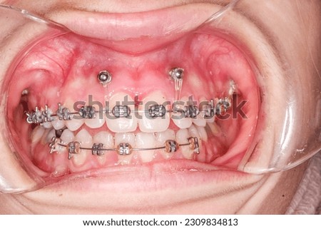 Frontal view of dental arches in biting teeth occlusion, orthodontic braces, elastic O-ring ligature and arch wire. Mini-implants in healthy gingival gum, lips retracted with cheek retractor. Royalty-Free Stock Photo #2309834813