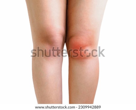 Knee effusion, fluid or water round the knee joint. Adult woman with knee swollen the swelling and redness of the skin because of fluid build up inside.  Royalty-Free Stock Photo #2309942889
