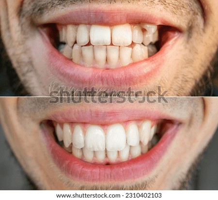 Close up teeth man. Before and after treatment teeth alignment, braces banner Royalty-Free Stock Photo #2310402103