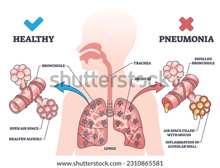Pneumonia illness medical comparison with healthy lungs outline diagram. Respiratory system problem with bronchi wall inflammation and air filled with mucus vector illustration. Bacterial infection. Royalty-Free Stock Photo #2310865581