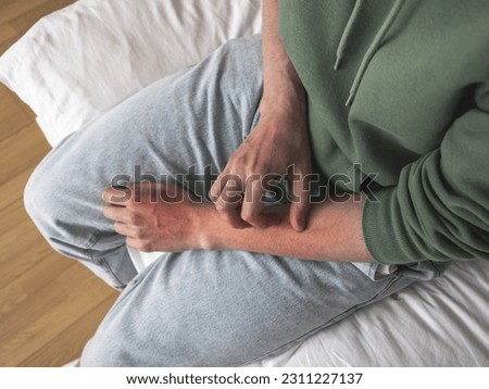 Man scratches hand, red damaged skin. Excoriation neurotic disorder, skin scratching, emotional stress or allergies Royalty-Free Stock Photo #2311227137