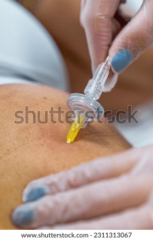 Female patient receiving carboxytherapy treatment in the abdomen with an injection for skin rejuvenation. Royalty-Free Stock Photo #2311313067