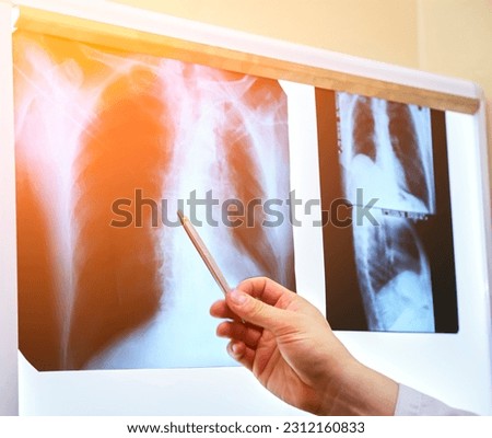 Black and white medical chest x-ray. A picture of the lungs in the doctor's office on the wall. Royalty-Free Stock Photo #2312160833