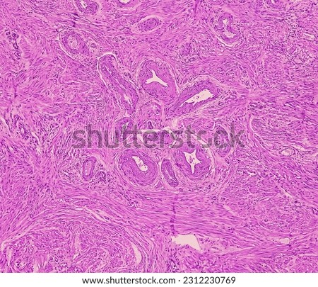 PROLAPSE-OF-UTERUS-HISTOLOGY Stock Photos and Images - Avopix.com