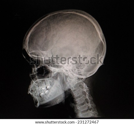 Film x-ray skull lateral