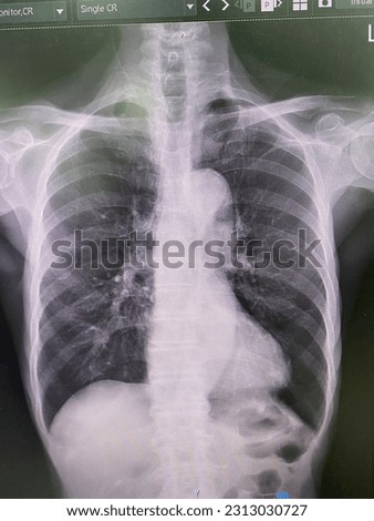 The picture of film chest x-ray  of normal patient  ,Medical Technology and healthcare concept.