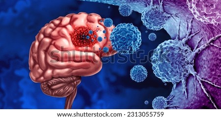 Glioma Cancer Tumor as malignant cells outbreak as a brain disease attacking neurons as a medical concept of neurological disease with 3D illustration elements.

