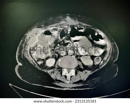The picture of computed tomography scan with contrast of patient who have bowel ischemia that have subcutaneous collection. Horizontal view. Medical Technology and Science concept.