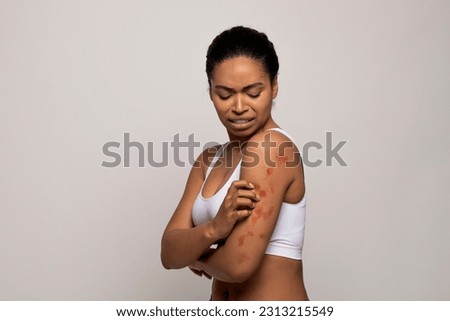 Sensitive Skin, Food allergy symptoms, Irritation, Eczema. Stressed young african american woman scratching red spots on her shoulders, isolated on grey studio background, copy space for ad Royalty-Free Stock Photo #2313215549