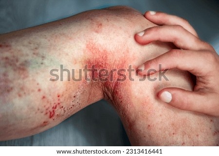 atopic dermatitis on the legs of a child treatment Royalty-Free Stock Photo #2313416441